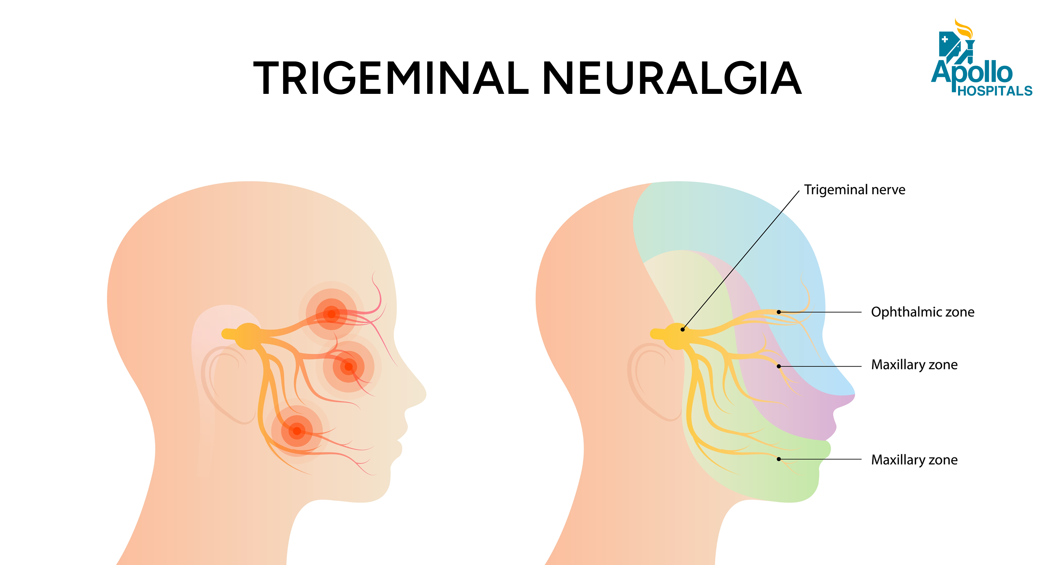 Trigeminal Neuralgia
